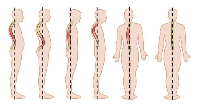 poruchy držení těla jako příčina hrudní osteochondrózy